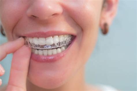 Choose Invisalign Over Traditional Braces Smile Brite Dentistry