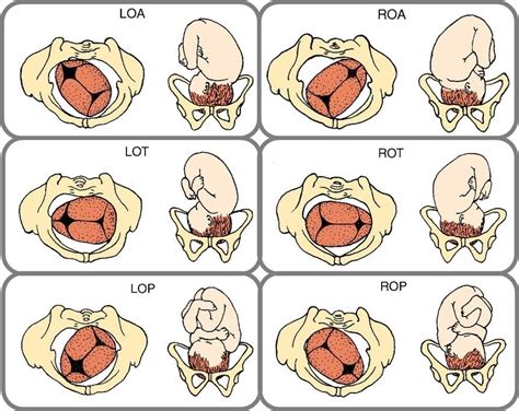 Variedade De Posição Fetal