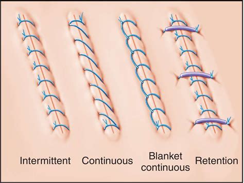 Types Of Stitches For Surgical Procedures