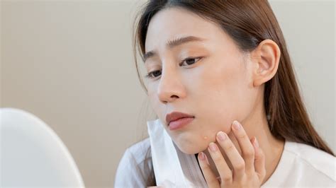 Dermatologist Recommended Solutions For Getting Rid Of Chin Acne