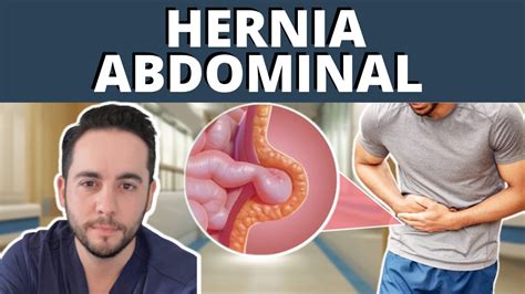 Hernias Abdominales Inguinal Umbilical Causas Síntomas