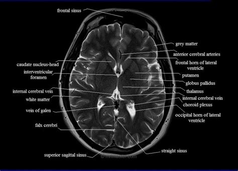 Brain Anatomy Radiology Mri Brain