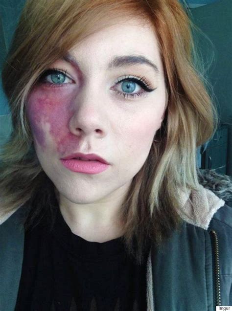 woman told she was too ugly to love and undateable proudly shows facial birthmark she s
