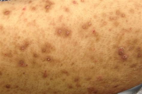 Derm Dx Pruritic Papules In A Healthy Year Old Woman Clinical Advisor