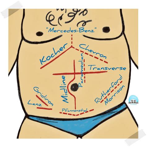 Abdominal Incisions The Names And Anatomical Locations The Scrub Nurse