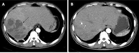 Contrast Enhanced Computed Tomography Ct Of The Liver A Abdominal
