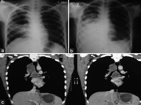 Chest X Ray Pa View Showing The Right Middle Lobe Consolidation A And