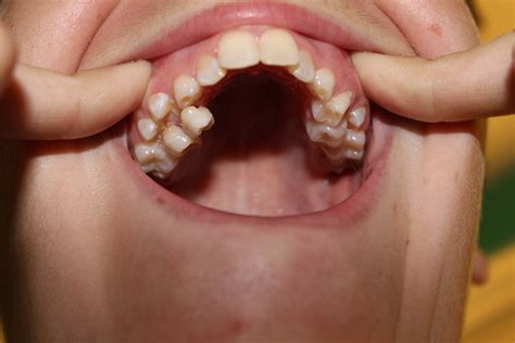 Another Row Of Teeth Dental Oddities Pinterest Teeth Hyperdontia