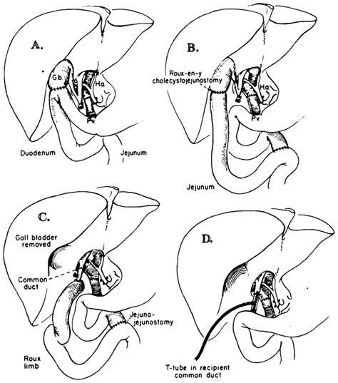 Ad Techniques Of Biliary Duct Reconstruction Used For Most Of The