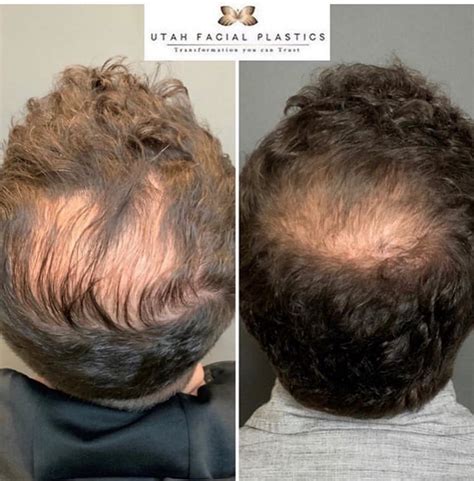 Early Signs Of Balding Crown