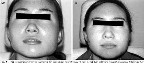 Treatment Of Unilateral Masseter Hypertrophy With Botulinum Toxin In