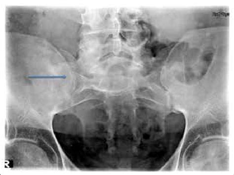 X Ray Of The Sacroiliac Joint Shows Bilateral Sacroiliitis Arrow With