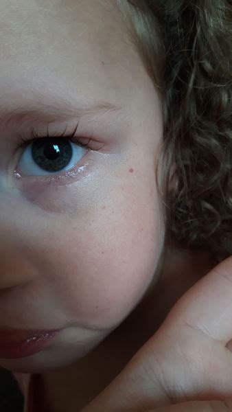 Red Dots On Toddlers Face Mumsnet