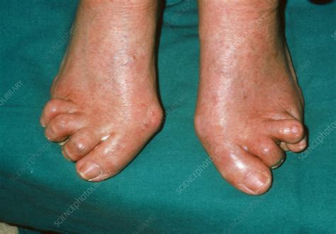 Feet Severely Affected By Rheumatoid Arthritis Stock Image M1100313 Science Photo Library