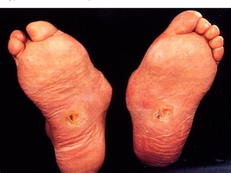Figure 1 From Predisposition To Charcot Foot Syndrome Through Other