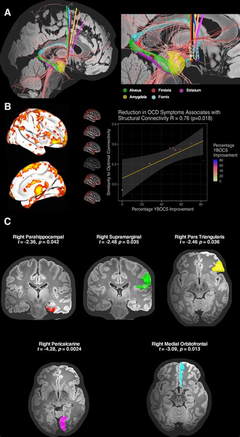 Structural Connectivity And Ybocs Reduction A White Matter Fibres