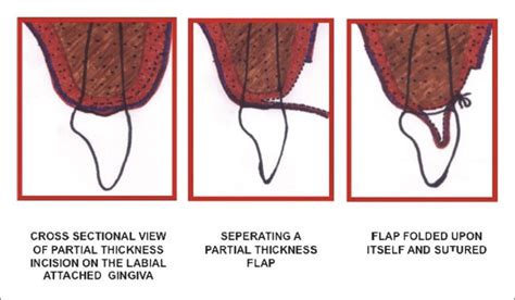 Diagrammatic Representation Of Surgical Procedure Download Scientific