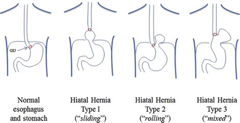 Paraesophageal Hernia Advances In Surgery