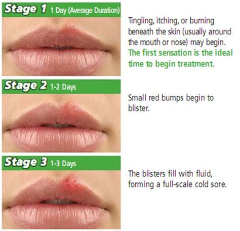 A cold sore forms in stages. How Do I Reduce Herpes Breakouts?