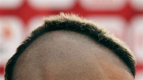 A Cure For Baldness Could Be Around The Corner The Atlantic