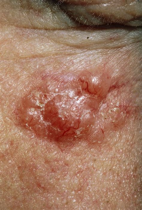 Basal Cell Carcinoma Skin Cancer Stock Image C0345442