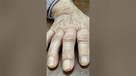An Elderly Patient With Loss Of Skin Turgor Due To Dehydration Youtube