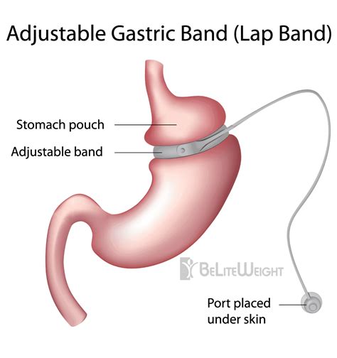 Adjustable Laparoscopic Gastric Banding Lap Band Procedures