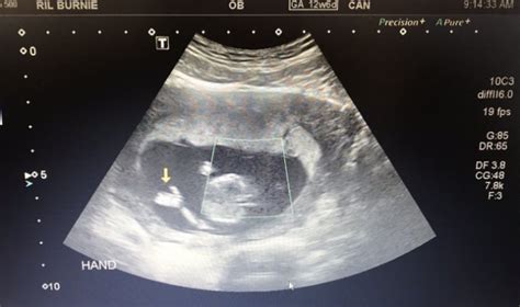 Anterior Placenta Ultrasound Babycenter