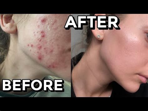 How I Cured My Acne | Cystic + Hormonal | All Natural NO Accutane 