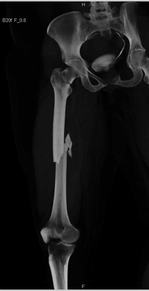 Spiral Femur Fracture Musculoskeletal System Medical Imaging Medical Illustration