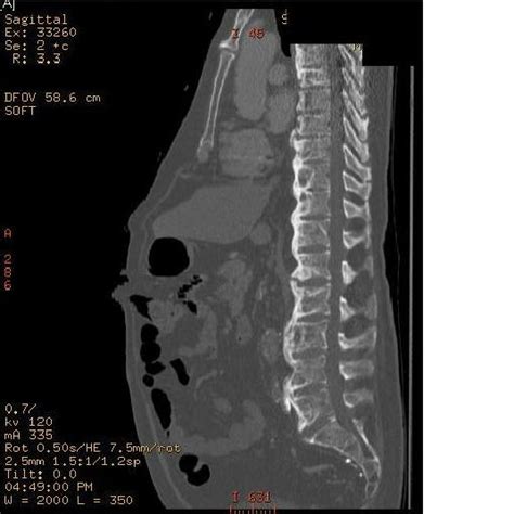 Ct Of Abdomen Sagittal Reconstruction Shows Normal Alignment Of