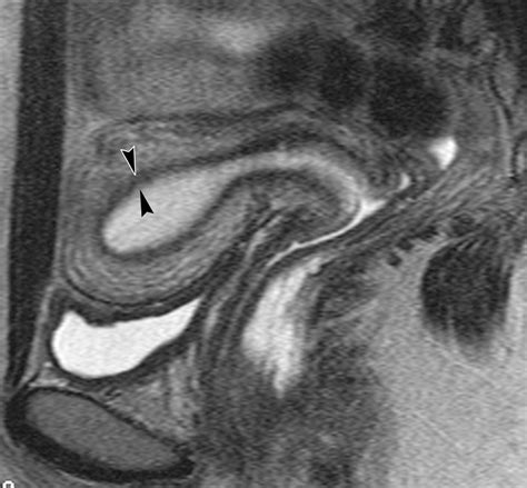 Diffusely Enlarged Uterus Evaluation With Mr Imaging Radiographics