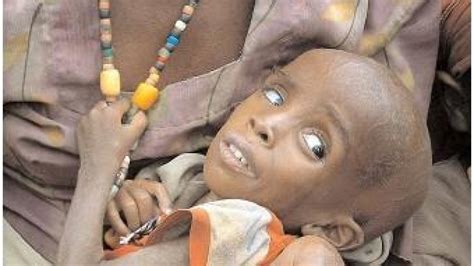 Oferă un ajutor copiilor cu malnutriţie severă din regiunea africană