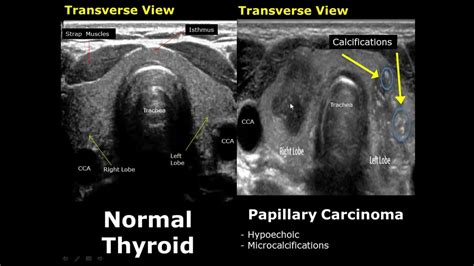 Thyroid Ultrasound Normal Vs Abnormal Image Appearances Comparison