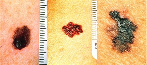 nefrocenter s advice on how to prevent melanoma nefrocenter