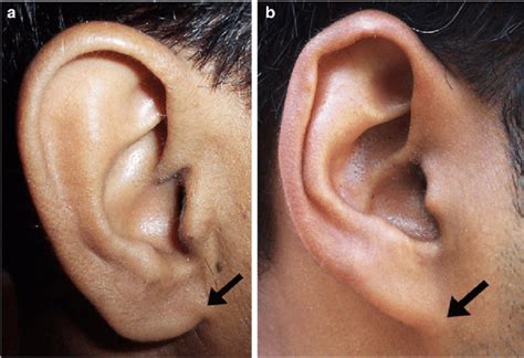 7 Adherence Of Lobule Ear Lobule Attachment To Cheek A Slightly