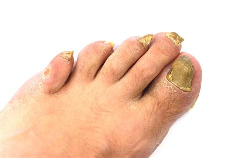 For this homemade treatment, all you need are two main ingredients: 9 Natural Ways to Treat Toenail Fungus at Home ...