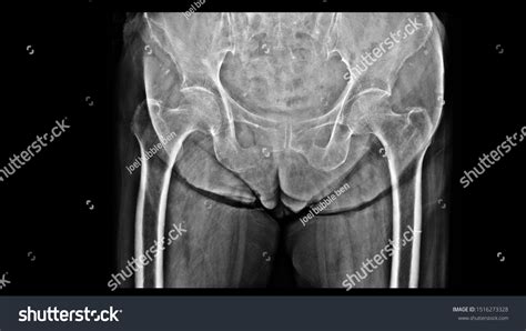Film Xray Hip Show Osteoporosis Bone Stock Photo 1516273328 Shutterstock