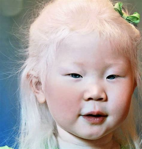 How Albinos From Various Races Look Like 22 Pics