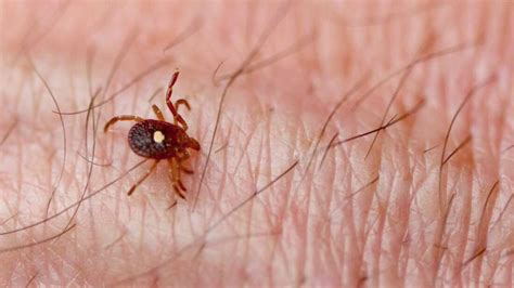 Alpha Gal Syndrome How A Ticks Saliva Can Make You Allergic To Meat