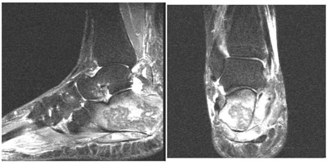 Calcaneal Osteomyelitis Presenting With Acute Tarsal Tunnel Syndrome A