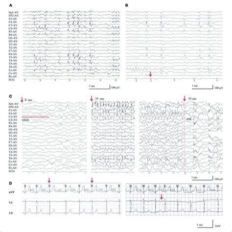 Eeg Discharges In The Patients With Ryr2 Mutations A Interictal