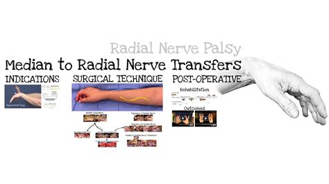 Median To Radial Nerve Transfers Feat Dr Mackinnon Youtube