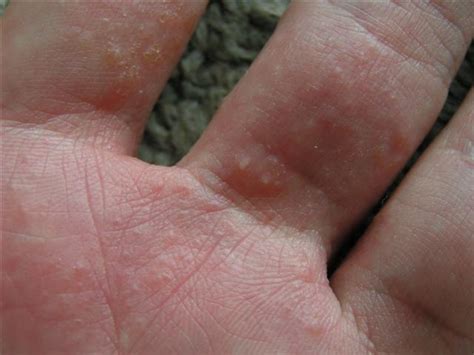Eczema Bumps On Fingers Dorothee Padraig South West Skin Health Care