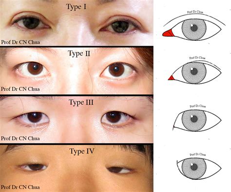 Eyelid Surgery By Prof Dr Cn Chua 蔡鐘能 Doc Do I Need Operation On My