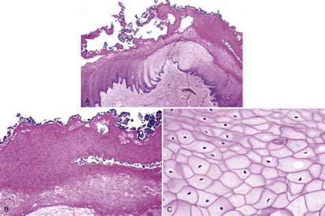 Frictional Keratosis Histology