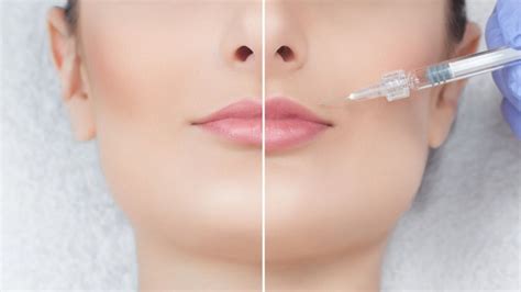 Preenchimento Labial Ml O Necess Rio Confira O Antes E Depois