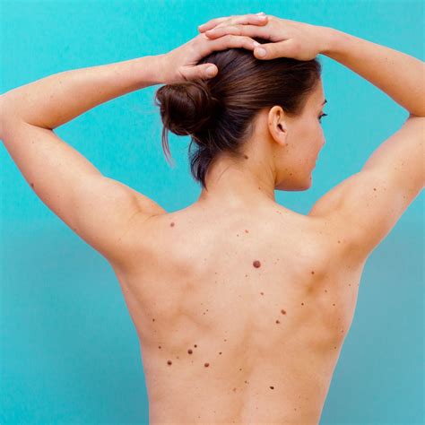 Skin Cancer Spots On Face Symptoms Update Berita Olahraga Dalam Luar