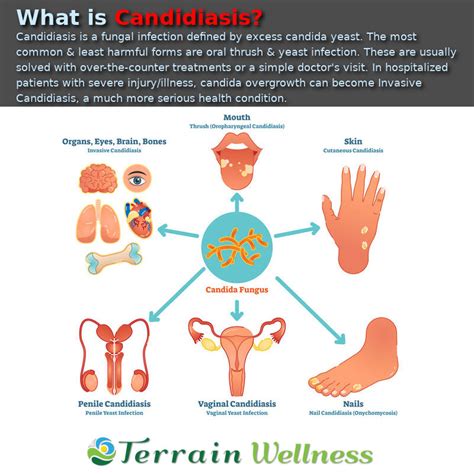 What Is The Meaning Of Candida Wholesale Store Save 56 Jlcatjgobmx