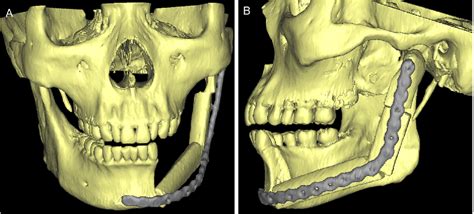 Figure From Mandibular Reconstruction With The Vascularized Fibula